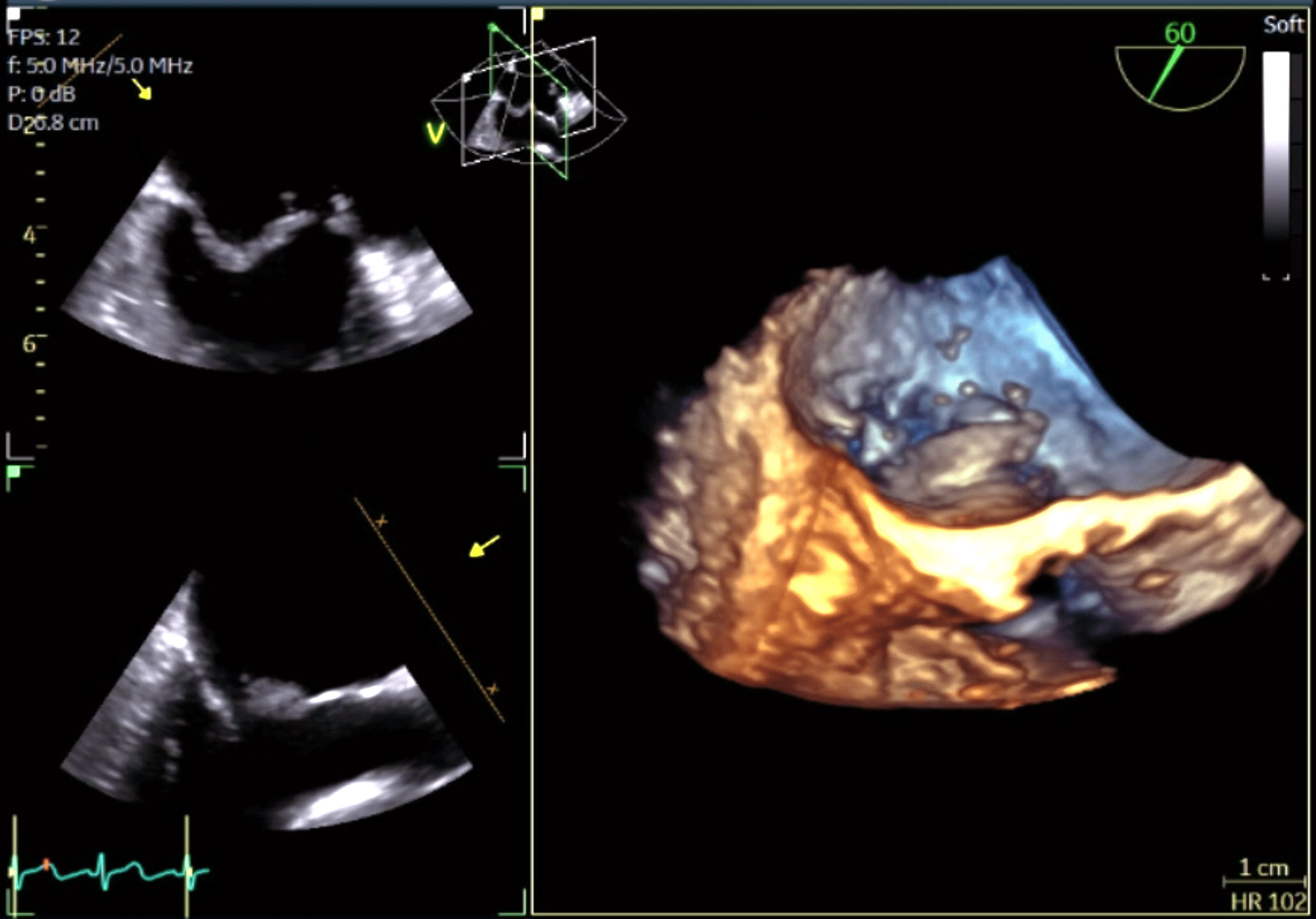 Cureus Acute Mitral Valve Regurgitation Presenting With Right Upper Lobe Opacification