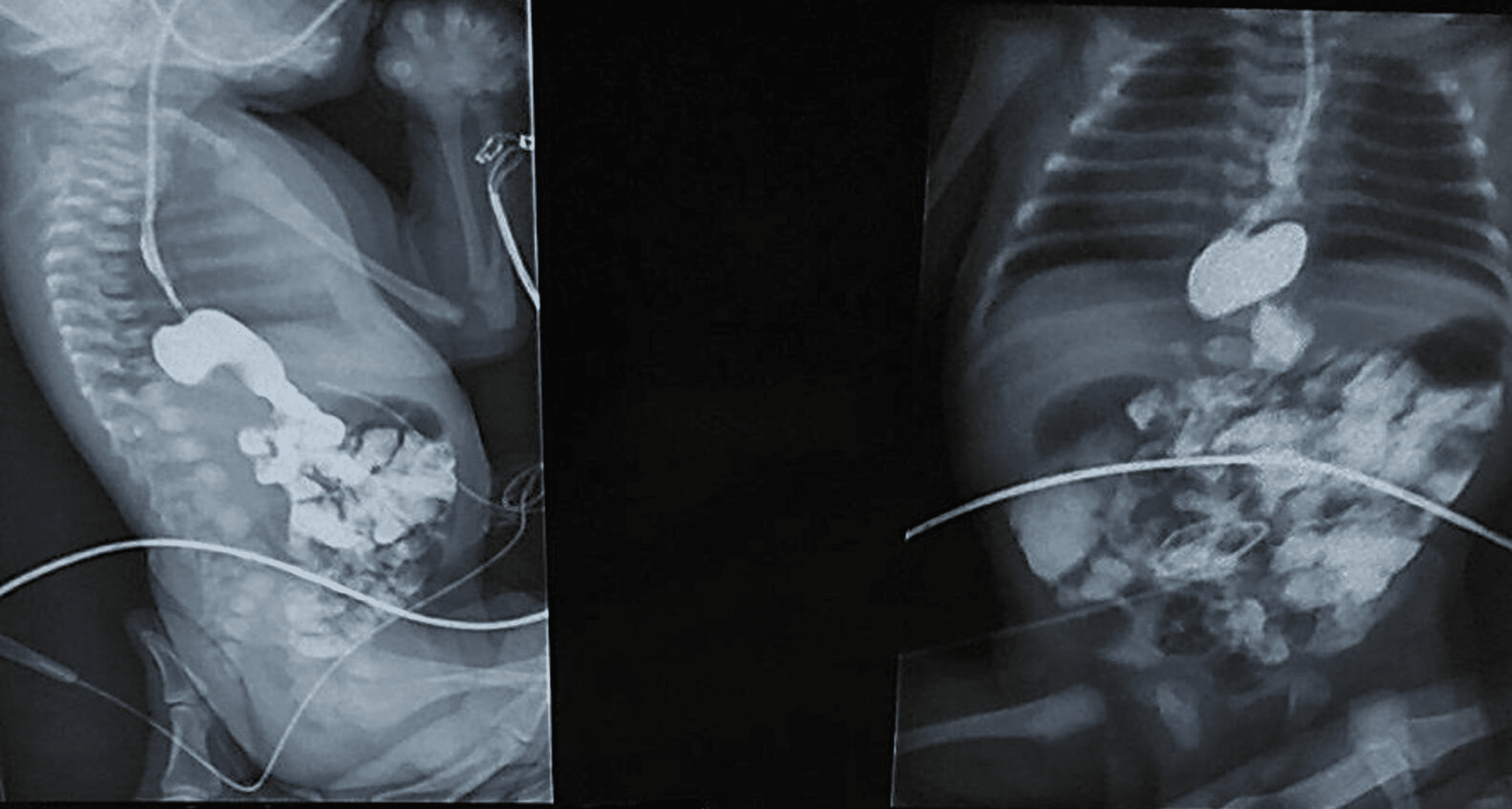 Cureus Paraesophageal Hernia In A Newborn Mimicking Esophageal Atresia