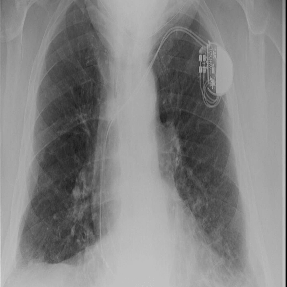 A Case Report On Solitary Extramedullary Plasmacytoma Of The Pleura