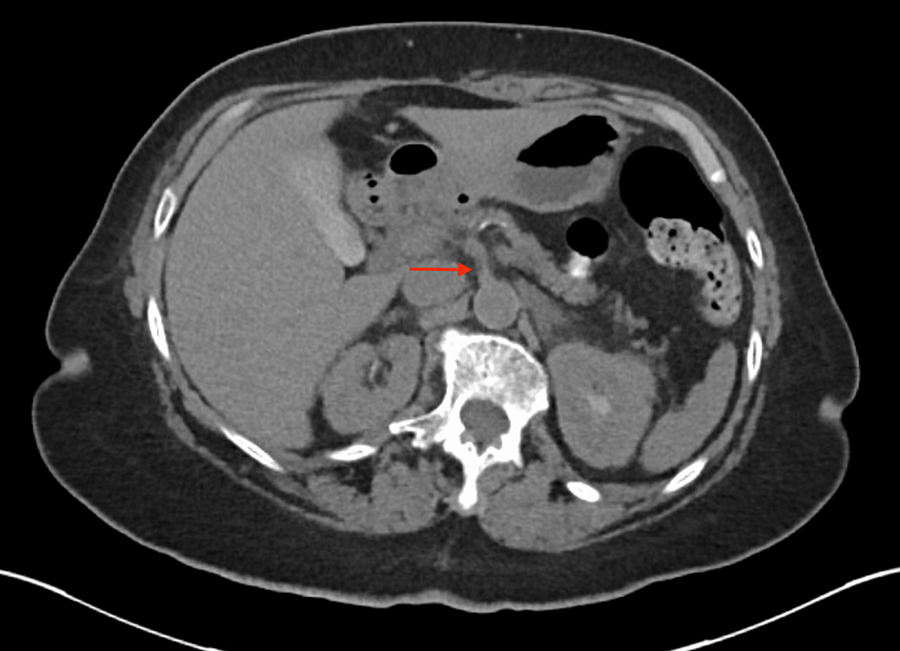 Cureus Incidental Discovery Of Nonrotation In A Patient With Nonspecific Abdominal Pain A