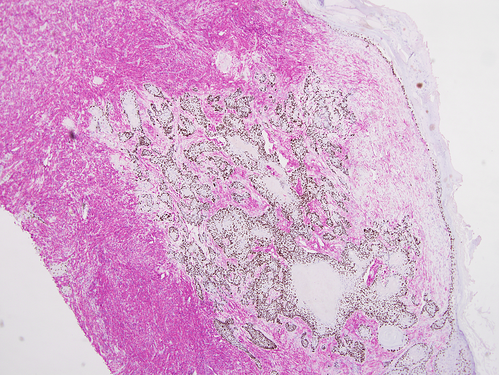 Cureus Collision Tumor Comprised Of Atypical Fibroxanthoma And Invasive Squamous Cell