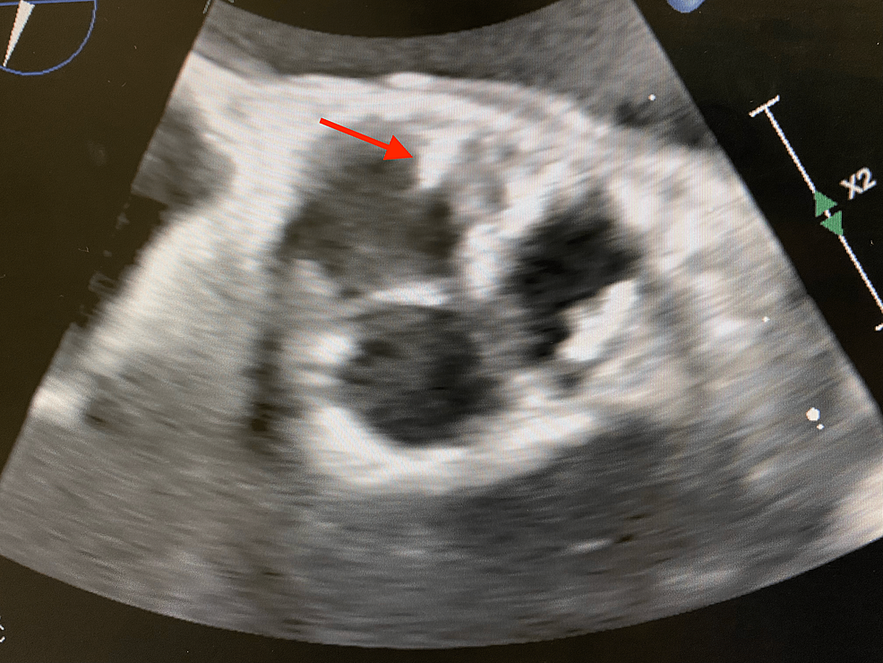 Atypical Presentation Of Infective Endocarditis With Native Aortic