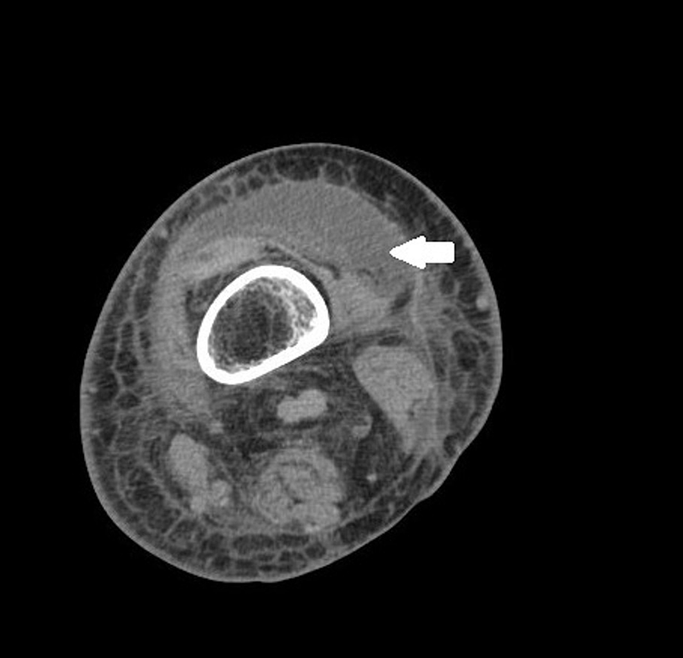 cureus-necrotizing-fasciitis-a-life-threatening-complication-of