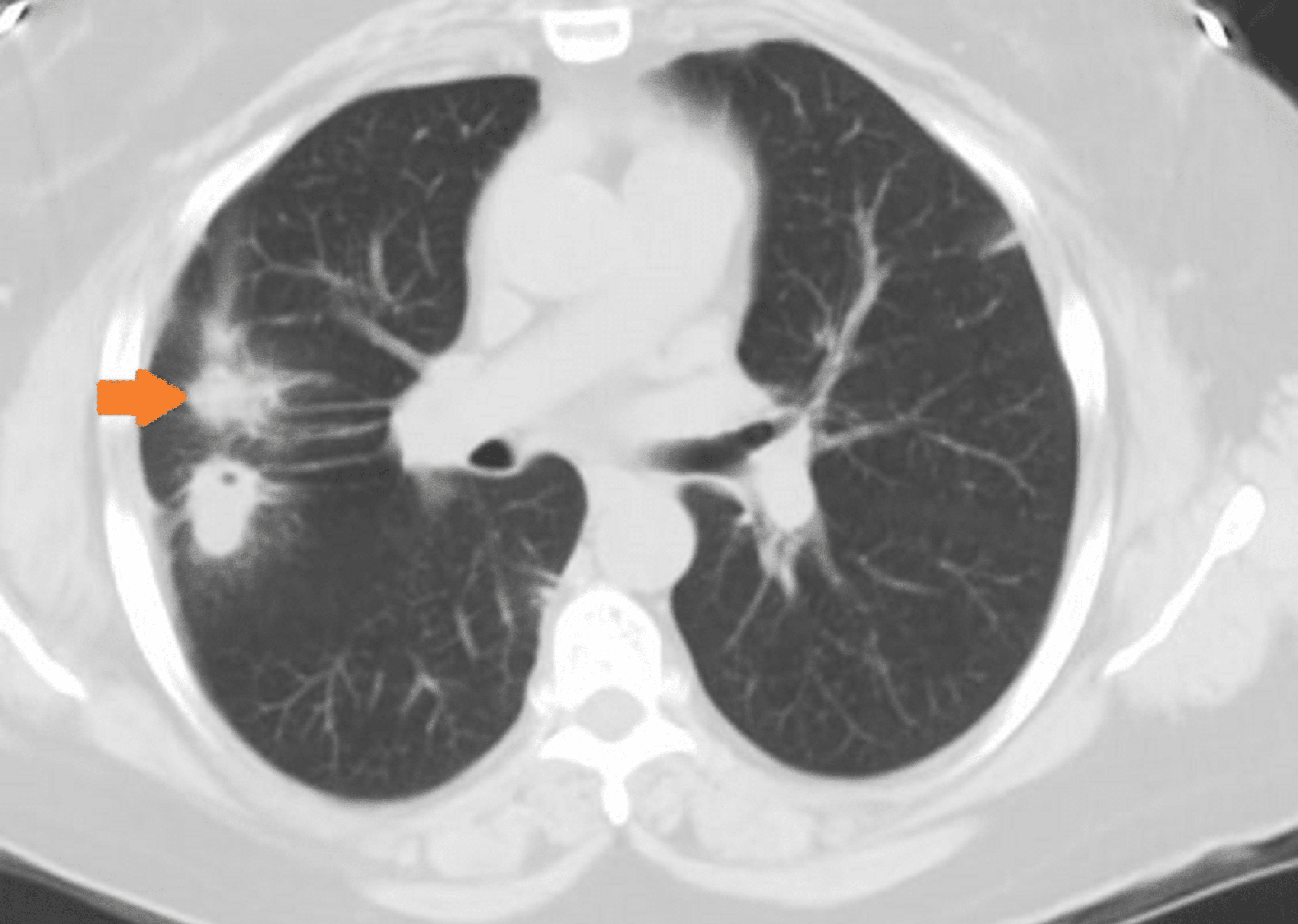 Cureus Limited Granulomatosis With Polyangiitis Presenting As