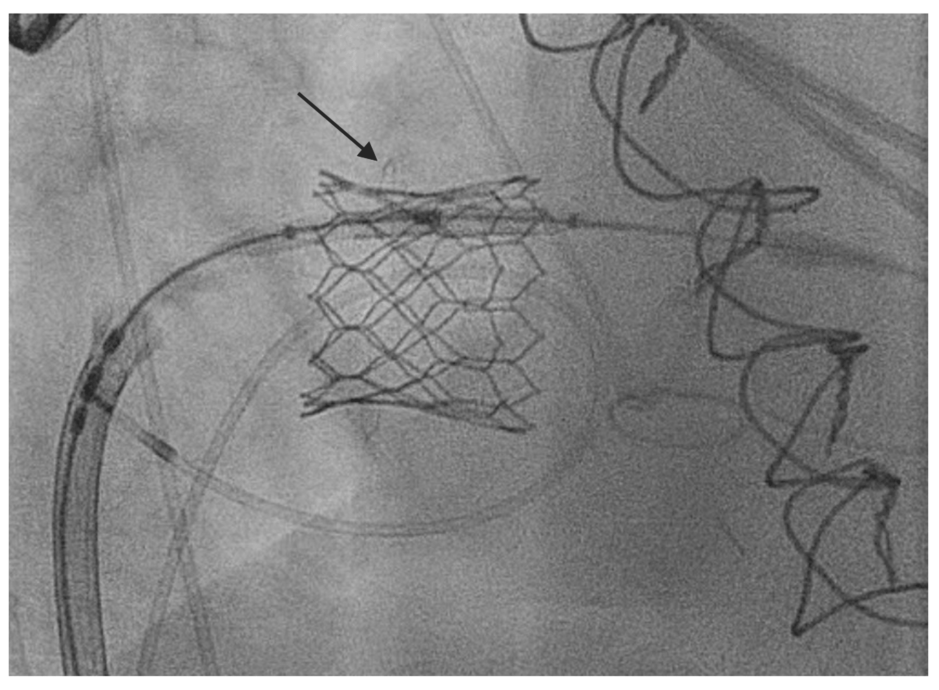 Cureus Premature Bioprosthetic Mitral Valve Dysfunction Due To Flail Leaflet Treated With