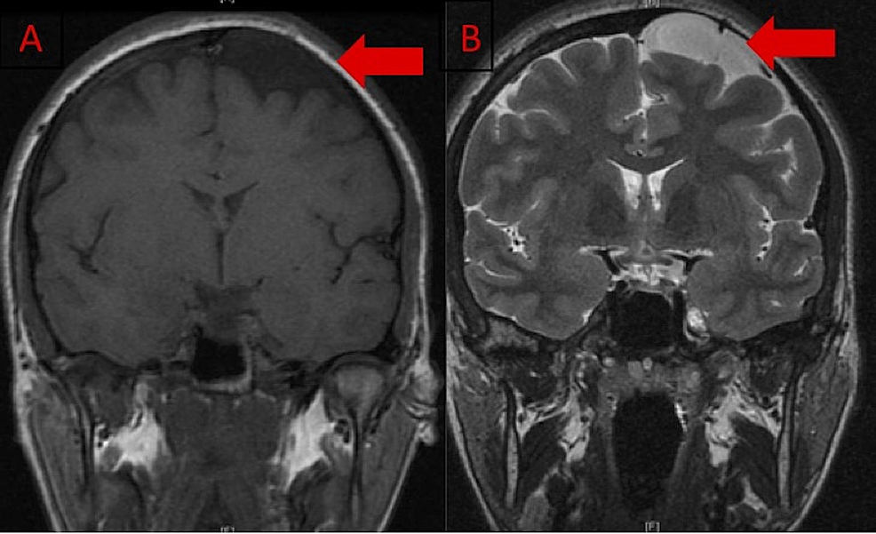 Cureus Spontaneous Acute Subdural Hematoma Associated With Arachnoid Cyst And Intra Cystic