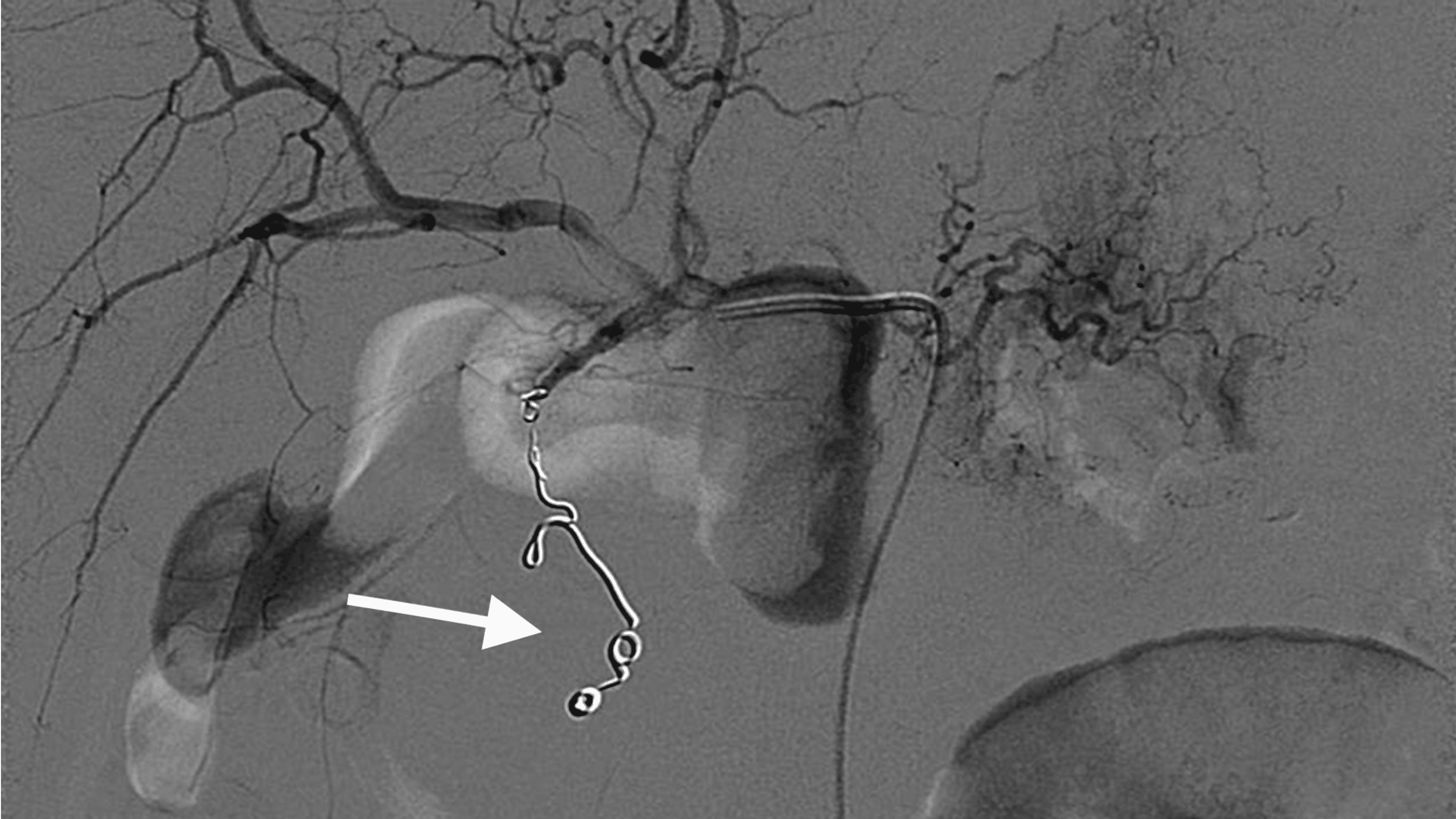 Cureus Giant Abdominal Pseudoaneurysm Secondary To Recurrent