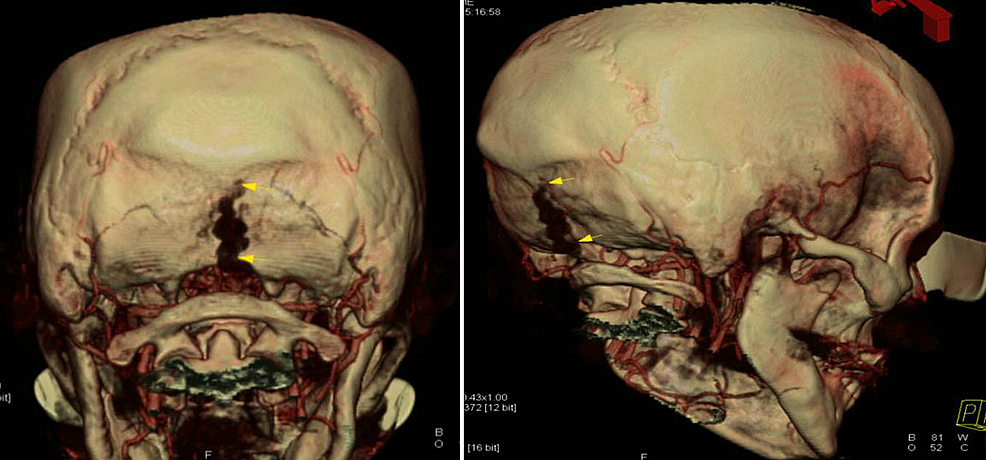 Cureus | Abnormal Large Central Occipital Emissary Vein: A Case Report
