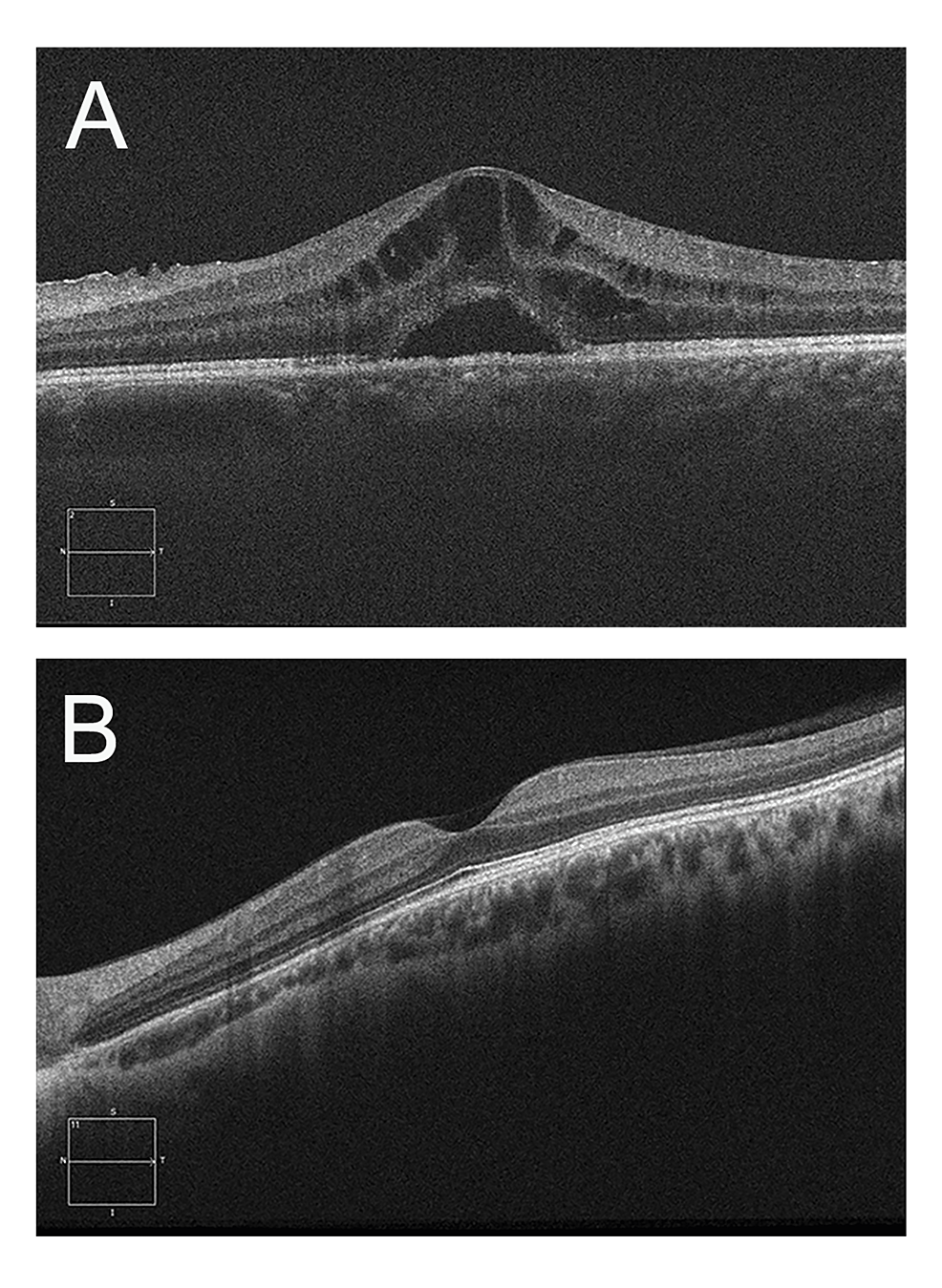 Pars Plana Vitrectomy With Internal Limiting Membrane Peeling For The