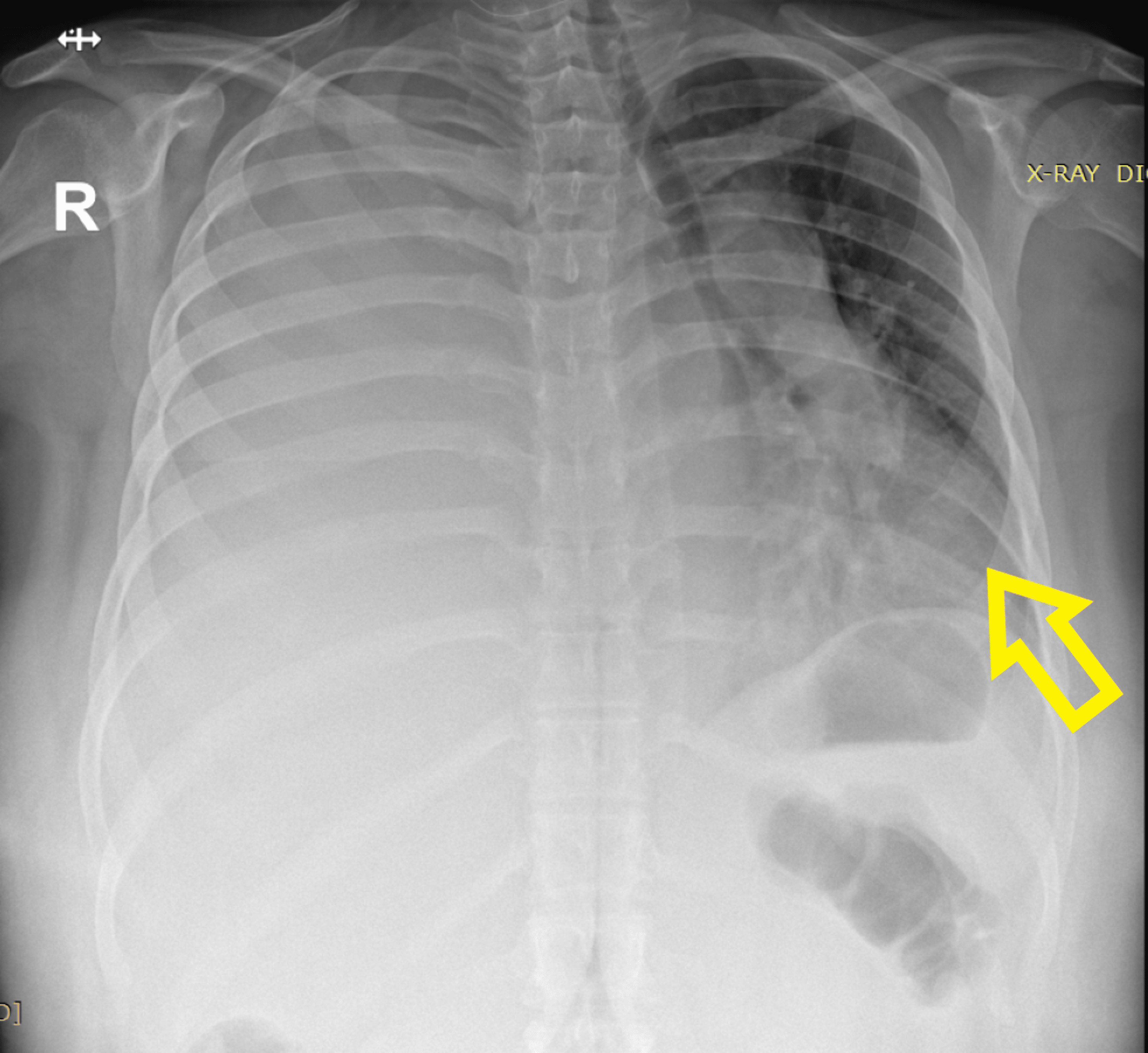 Cureus Use Of An Endobronchial Blocker Where A Double Lumen Tube