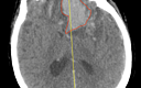 Intraparenchymal Hematoma With Significant Mass Effect Treated With