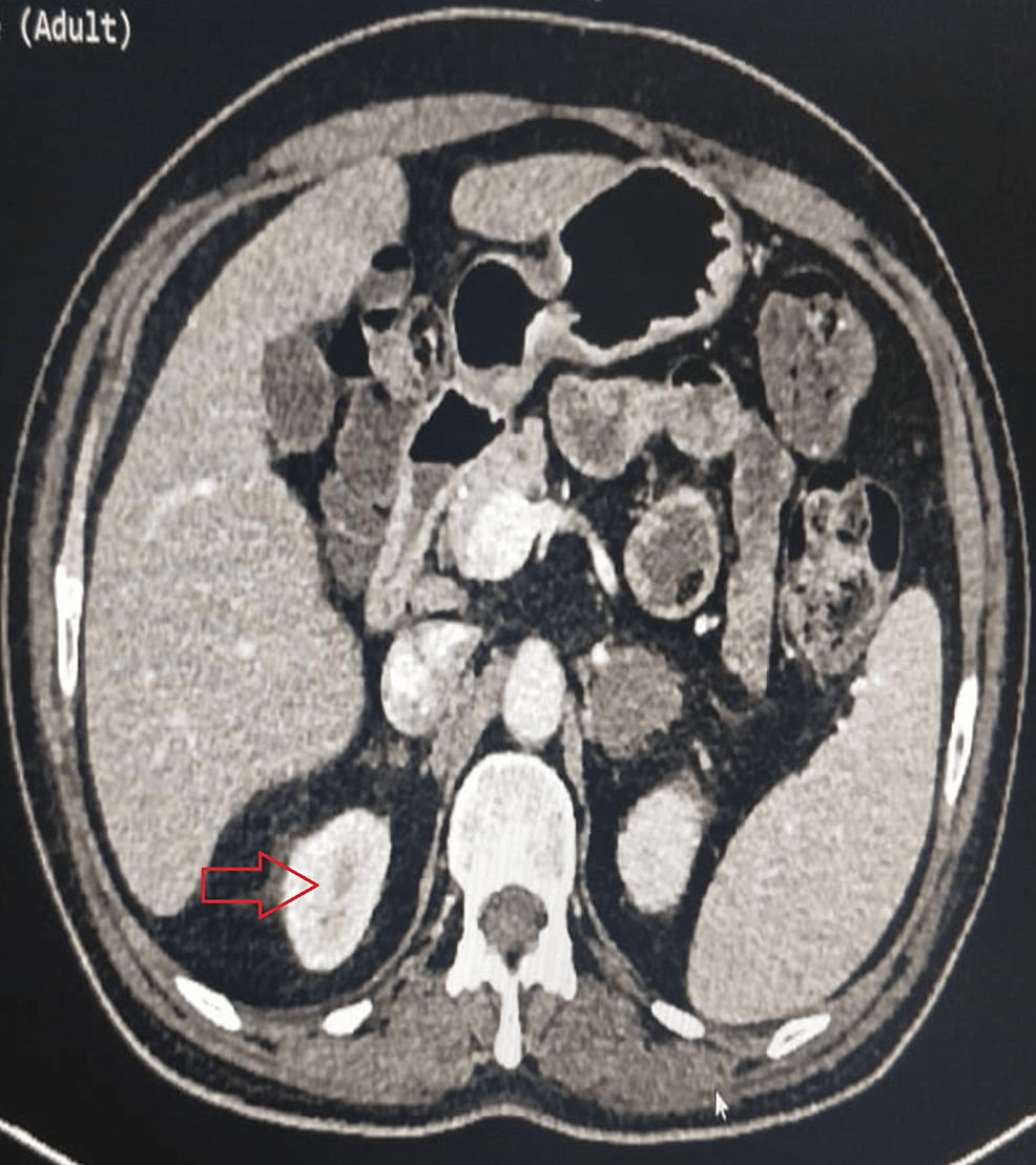 Cureus A Rare Case Of Disseminated Histoplasmosis With Hemophagocytic