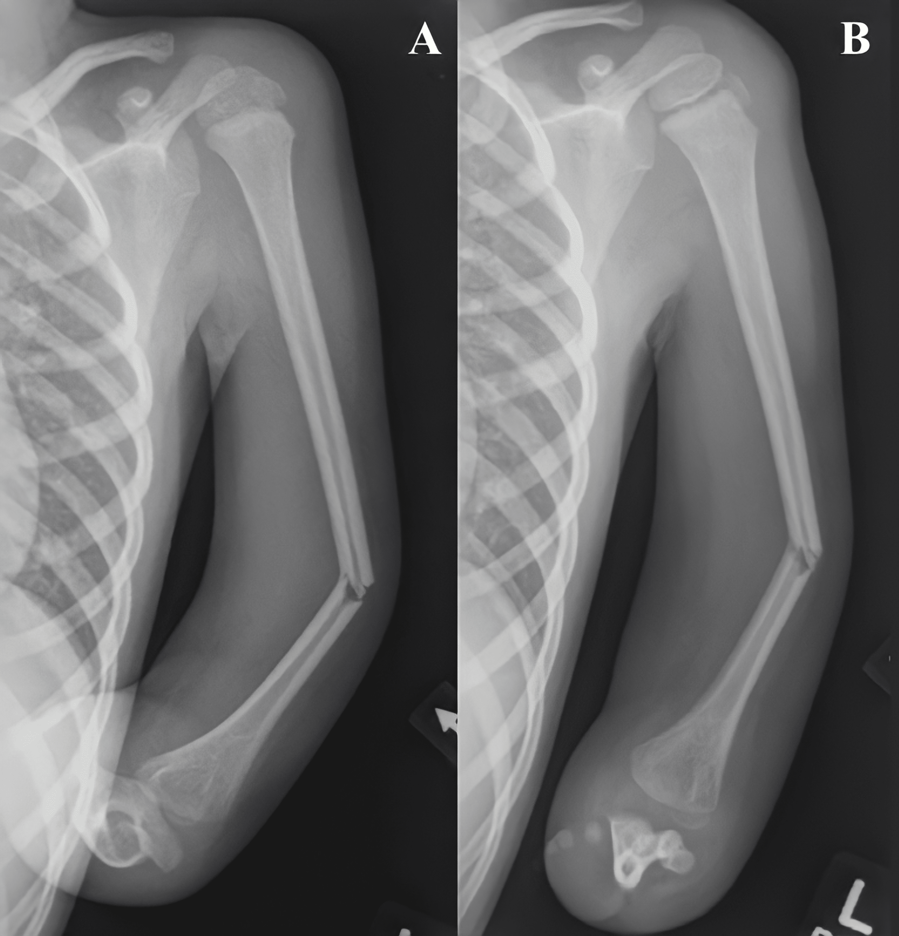 Cureus Novel Use Of A Shoulder Spica Treatment For Midshaft Humerus