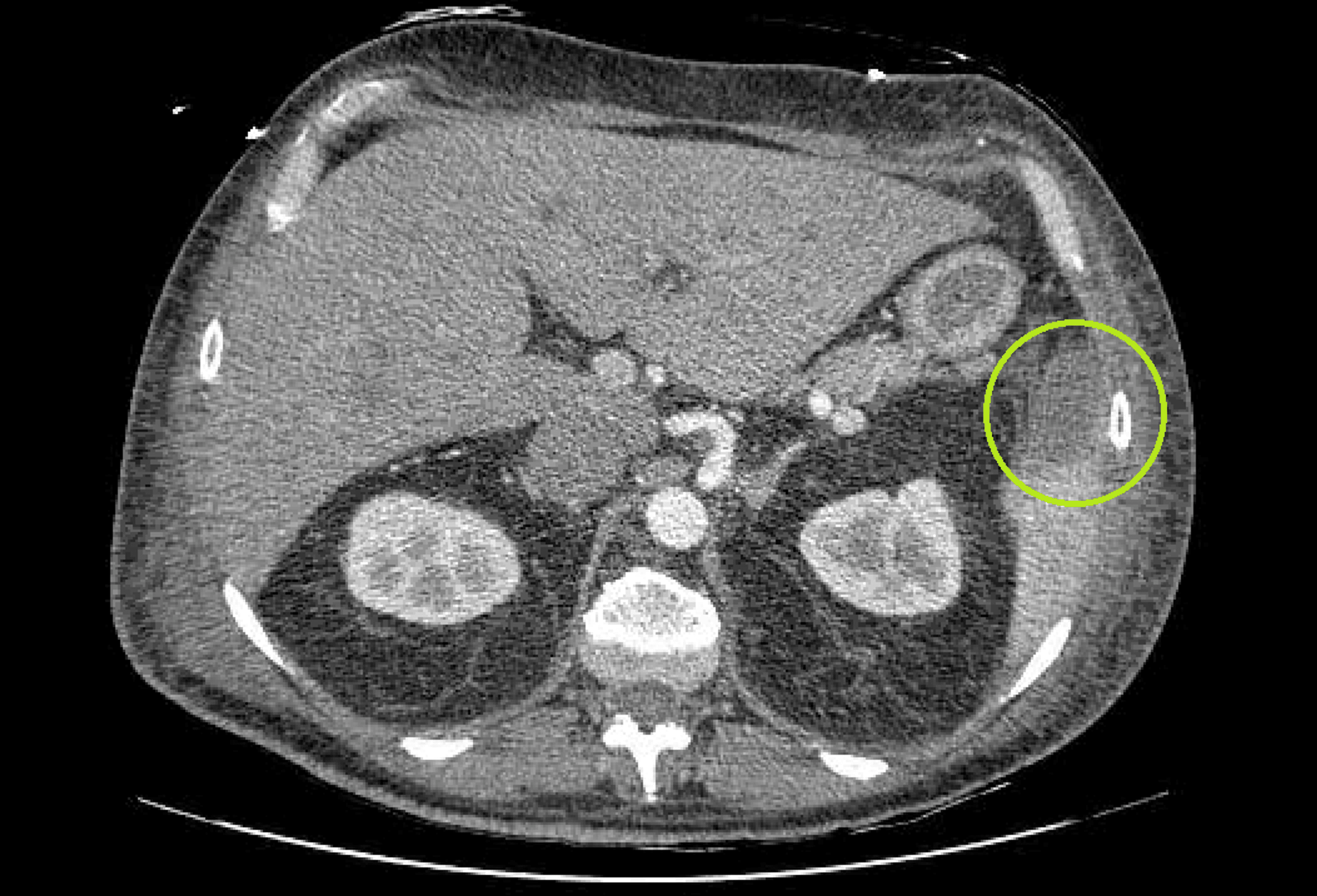 Cureus A Case Of Left Sided Infective Endocarditis Of Multiple Native