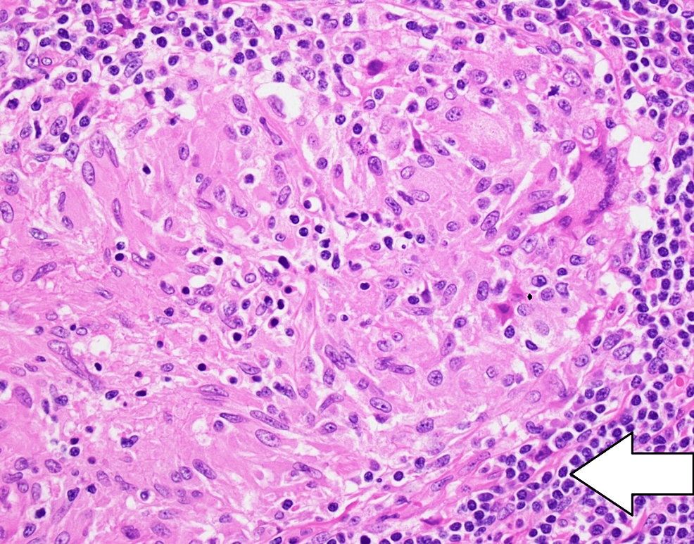 A 65 Year Old Male With Classic Cardiac Sarcoidosis Case Report And