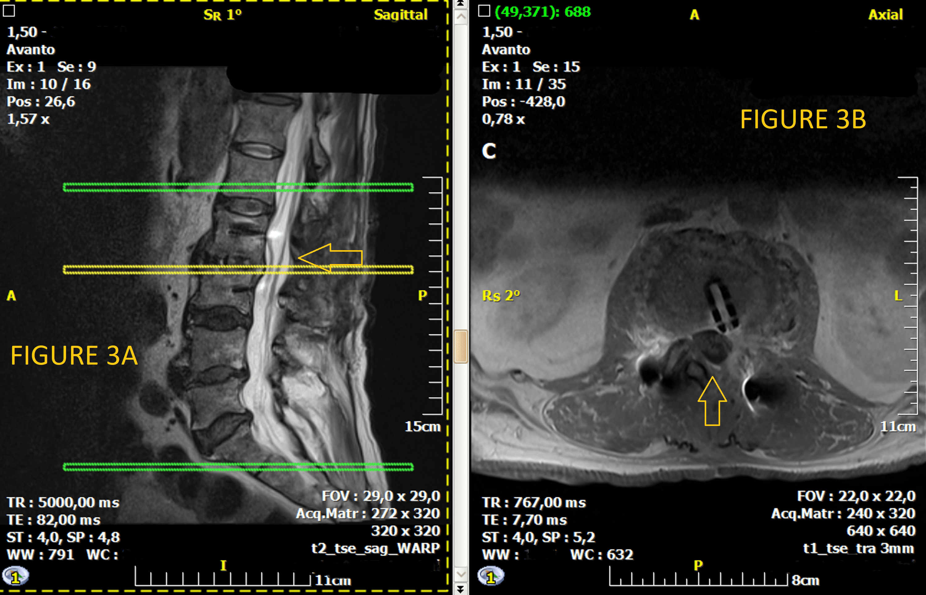 Cureus Diabetic Lumbosacral Radiculoplexus Neuropathy As An Early