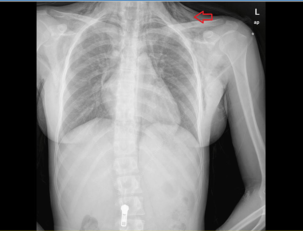 A Rare Case Of Spontaneous Pneumomediastinum In A Female After Shouting