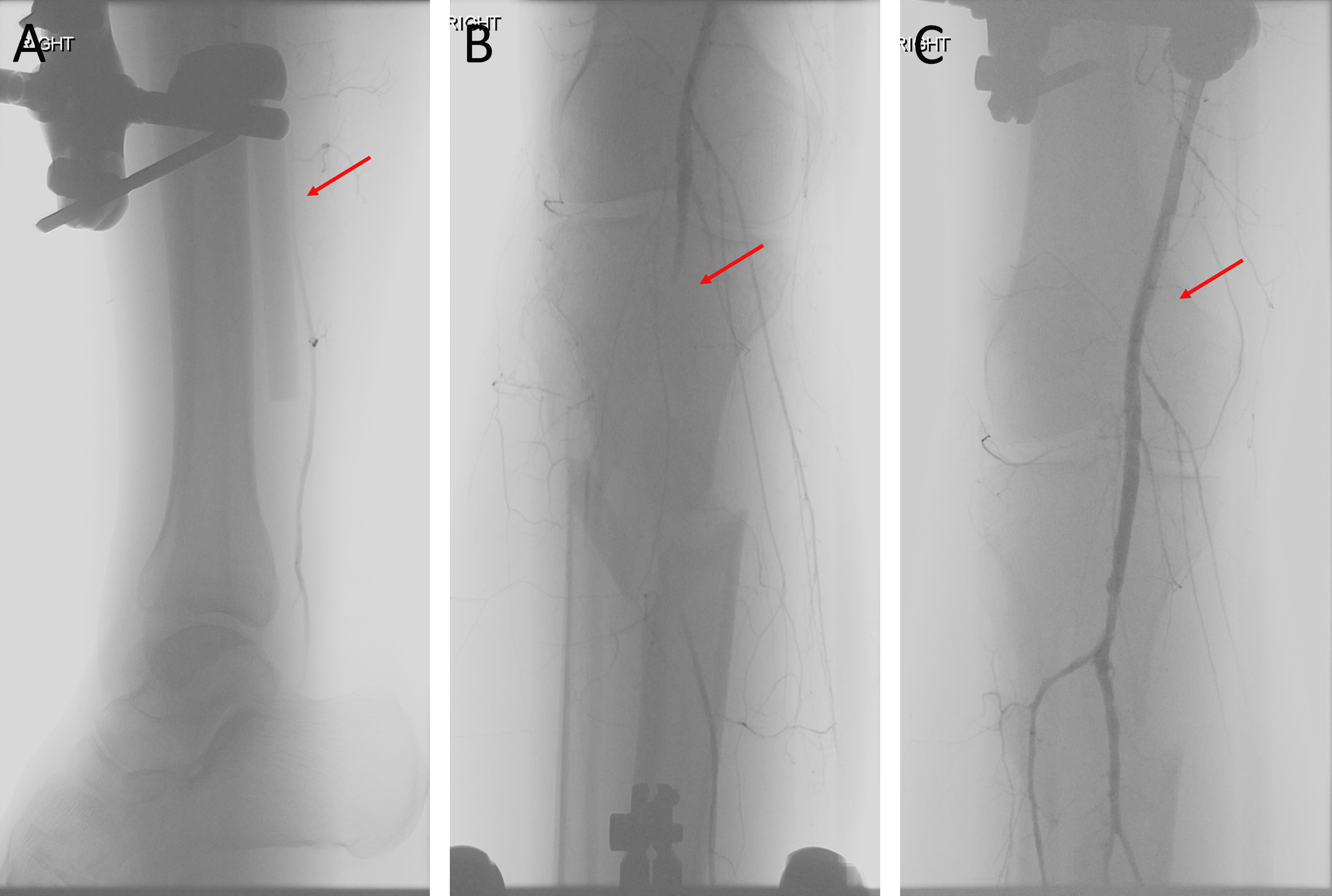 Cureus Endovascular Repair Of A Traumatic Popliteal Artery Injury