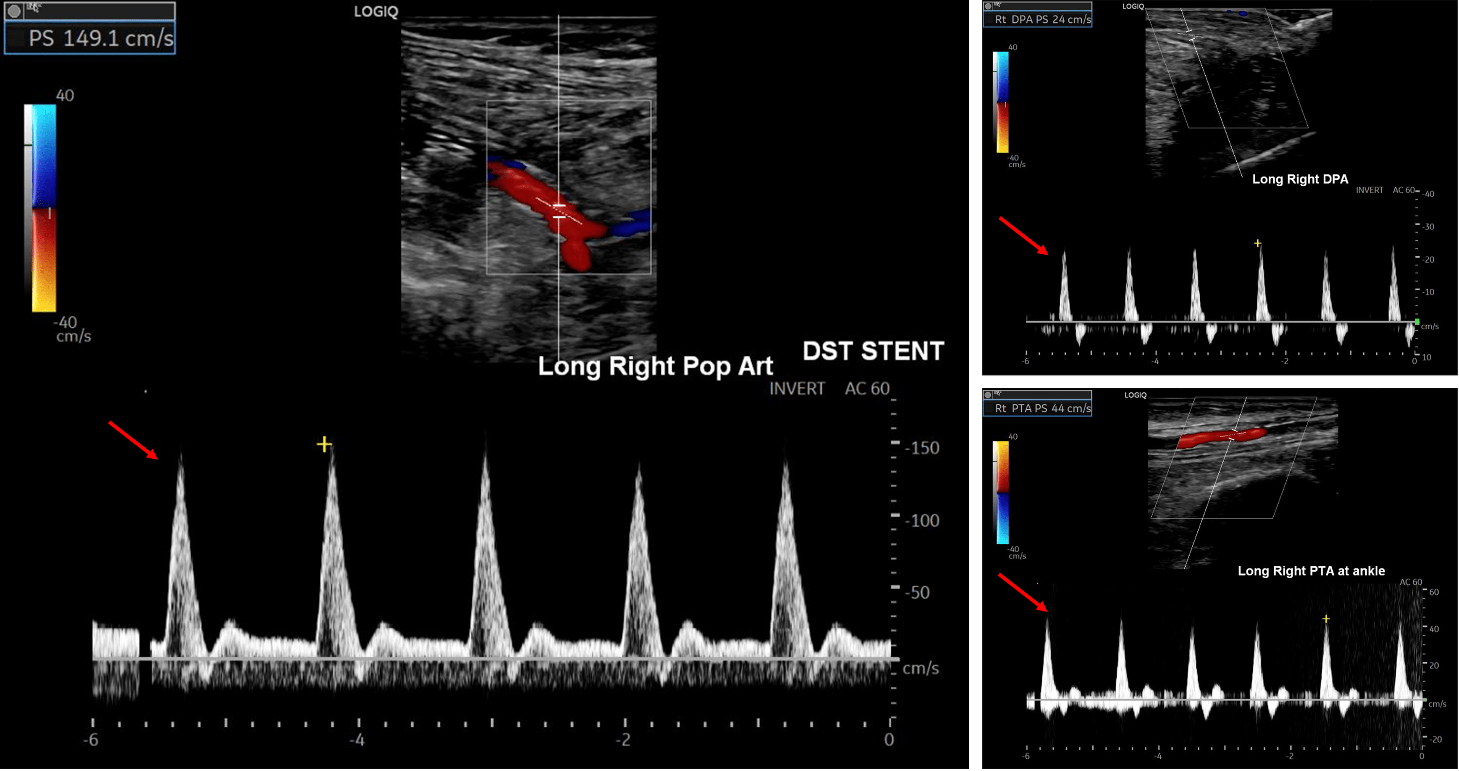 Cureus Endovascular Repair Of A Traumatic Popliteal Artery Injury