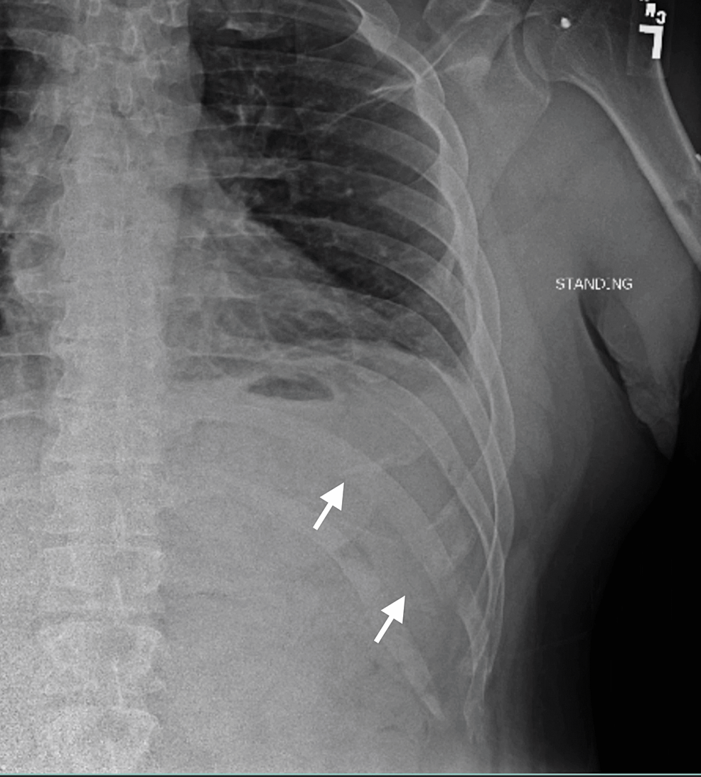 Cureus Outpatient Surgery For Rib Fracture Fixation A Report Of