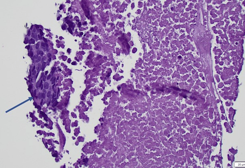 Cureus A Rare Case Of Aggressive Systemic Mastocytosis With Skeletal