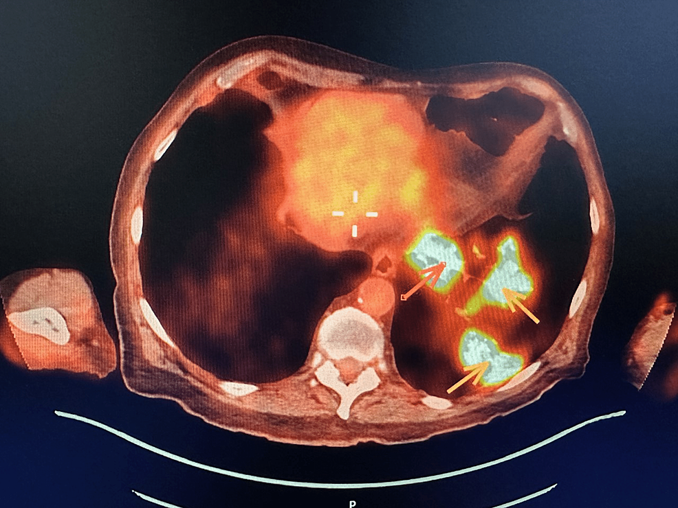 Cureus Blastomycosis Presenting As A Primary Tracheal Tumor A Rare