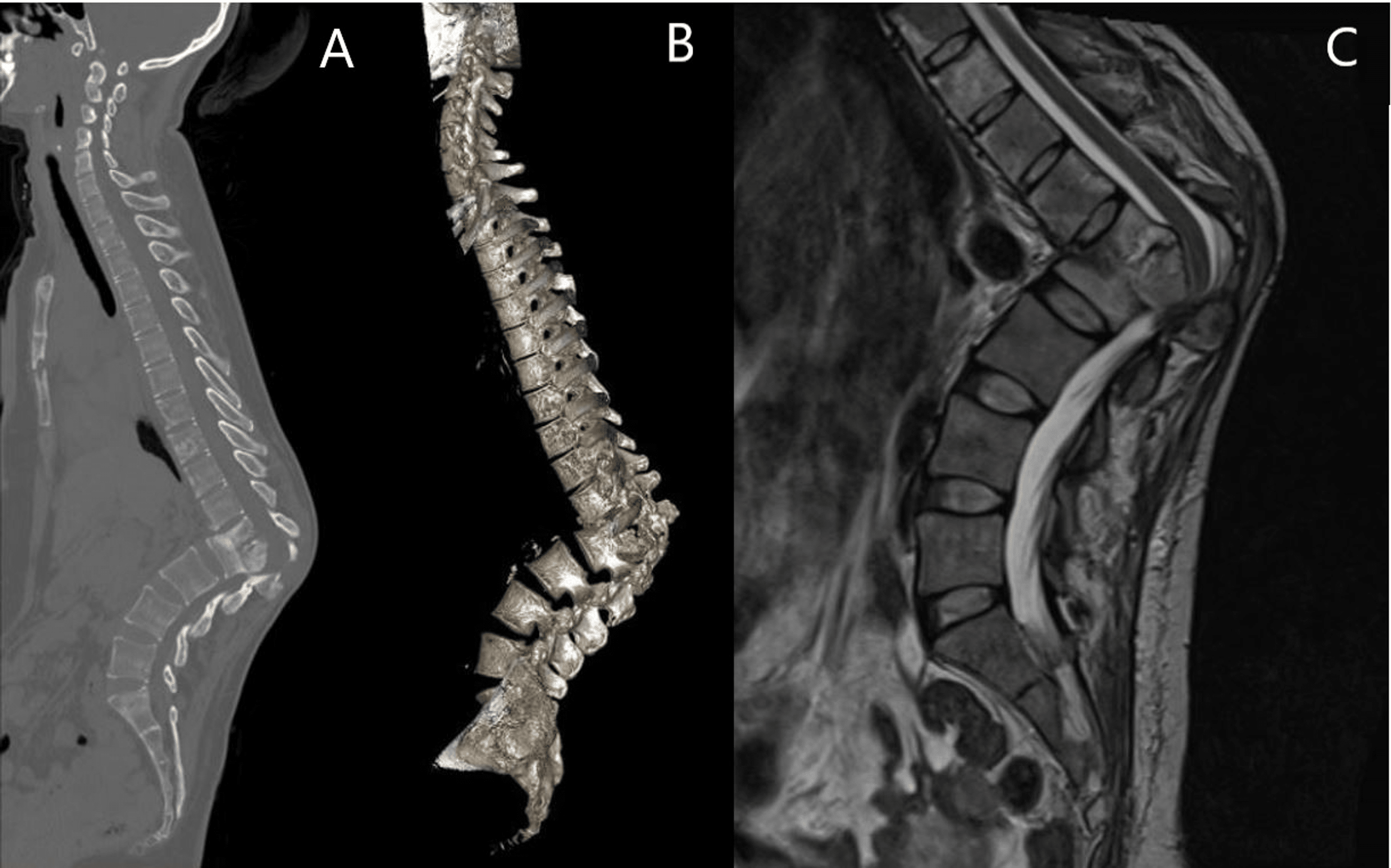 Cureus Single Stage Posterior Approach For A Neglected Severe