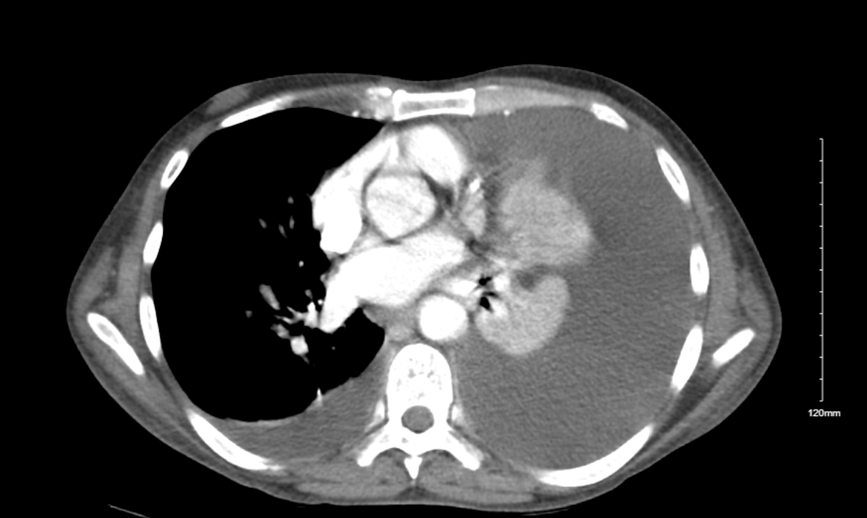 Cureus Black Pleural Effusion As A Complication Of Acute Pancreatitis