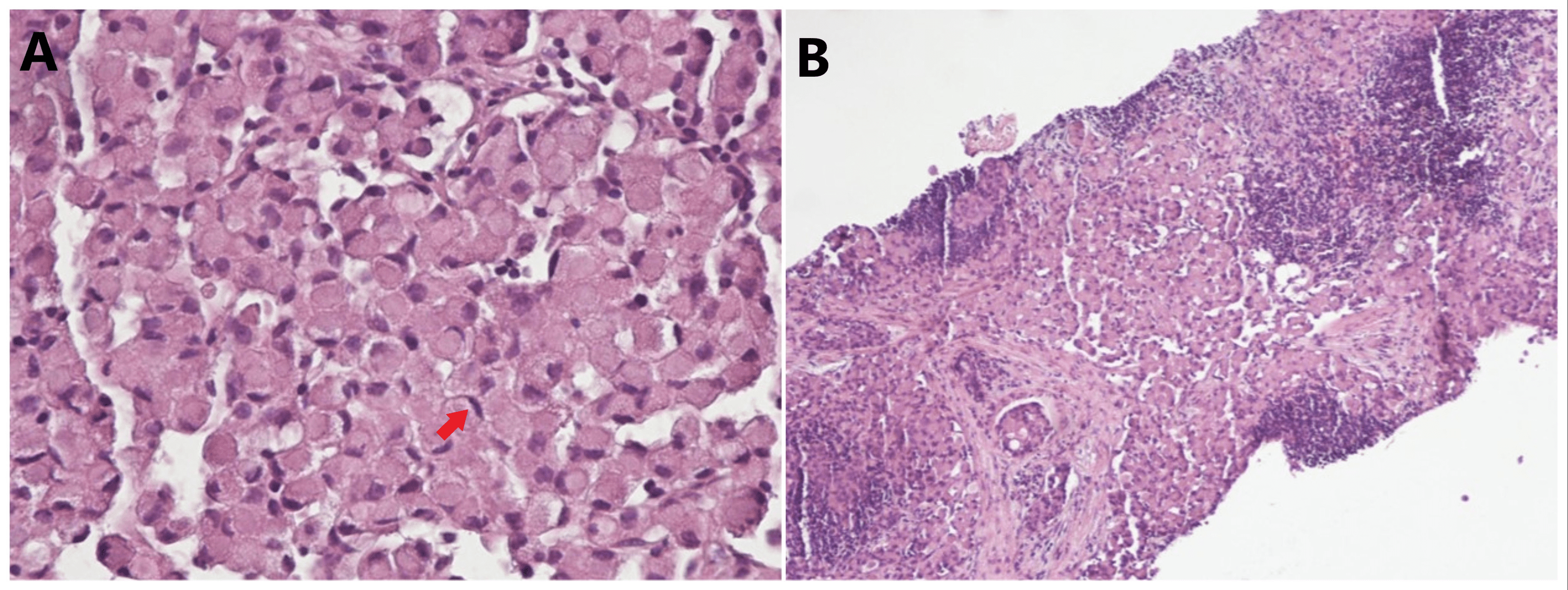 Cureus A Rare Case Of Metastatic Gastric Signet Ring Cell