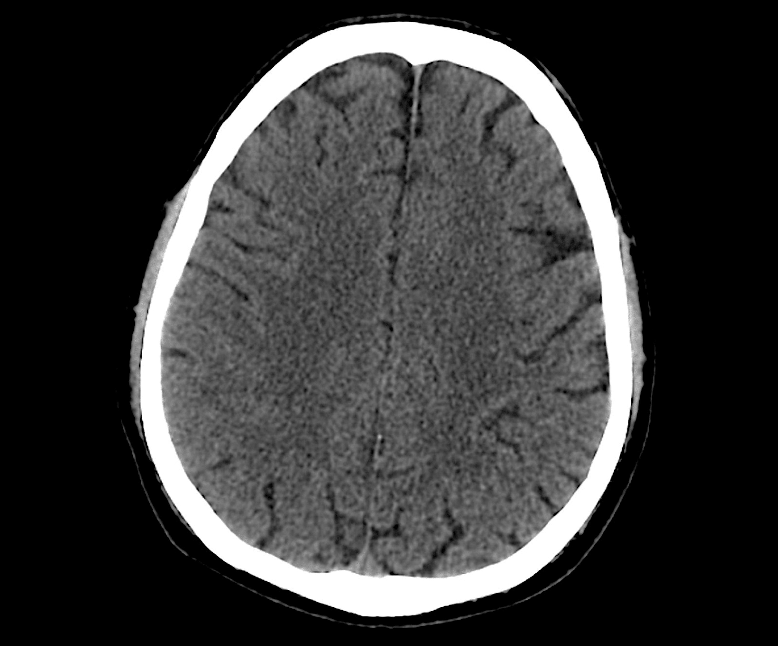 Cerebral Air Embolism Following Transthoracic Lung Biopsy Successfully