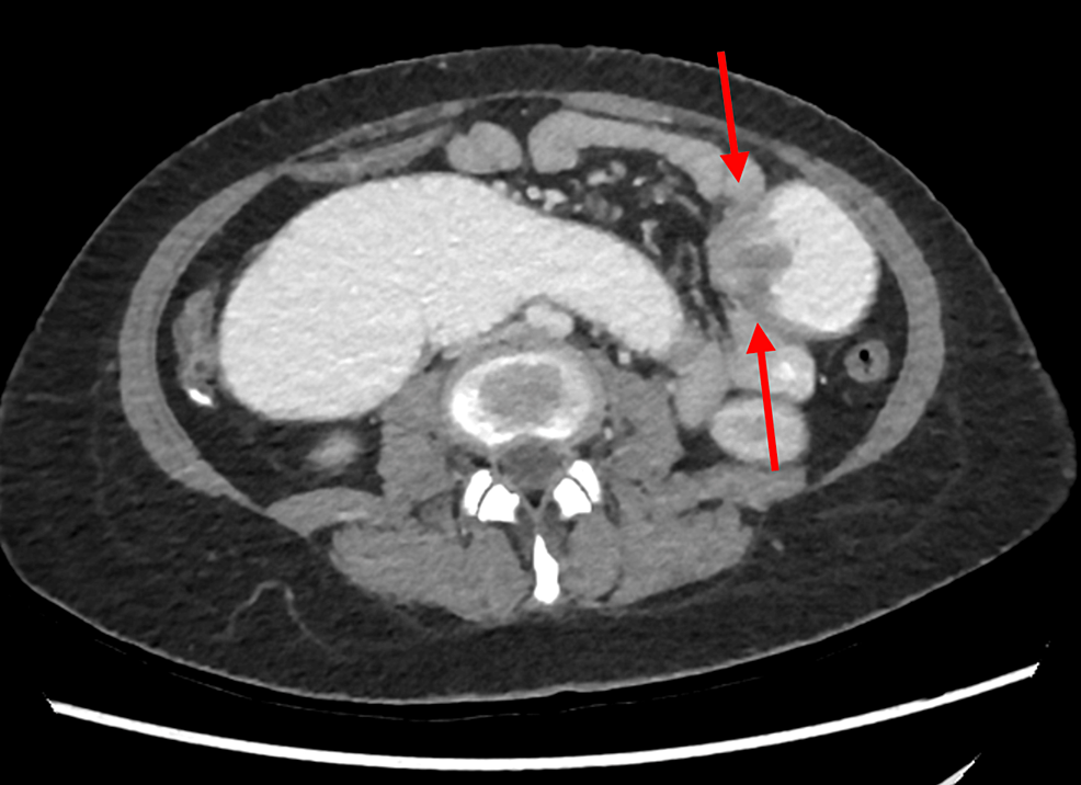 Cureus Primary Adenocarcinoma Of The Jejunum Case Report Of Rare Small Bowel Neoplasm