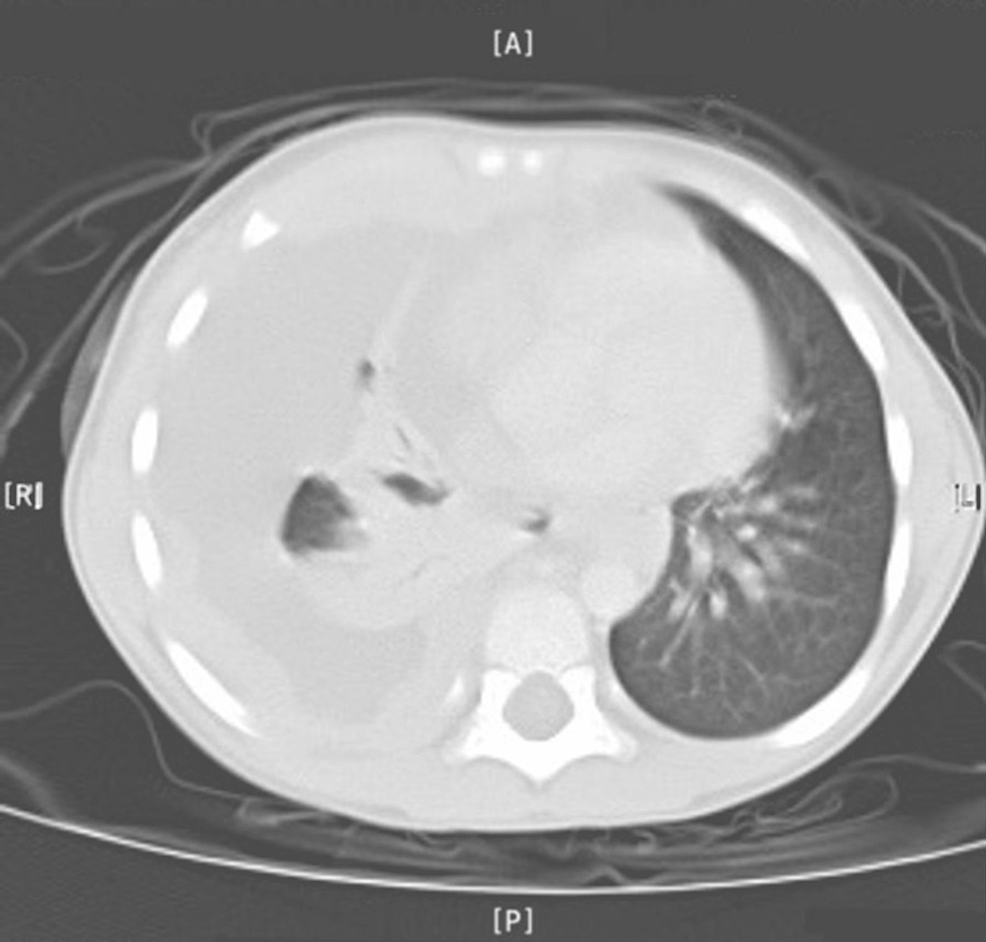 Malignant Pleural Effusion In Pediatrics A Rare Presentation Cureus