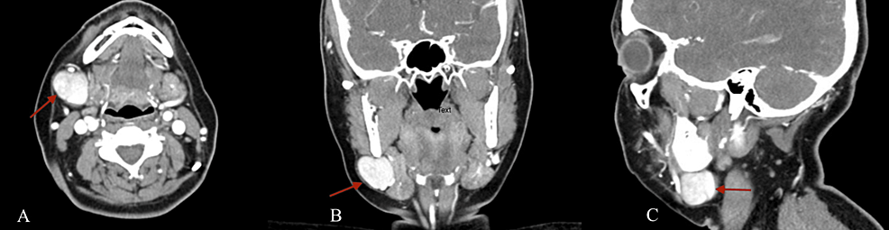 Idiopathic Facial Vein Aneurysm A Case Report And Review Of The