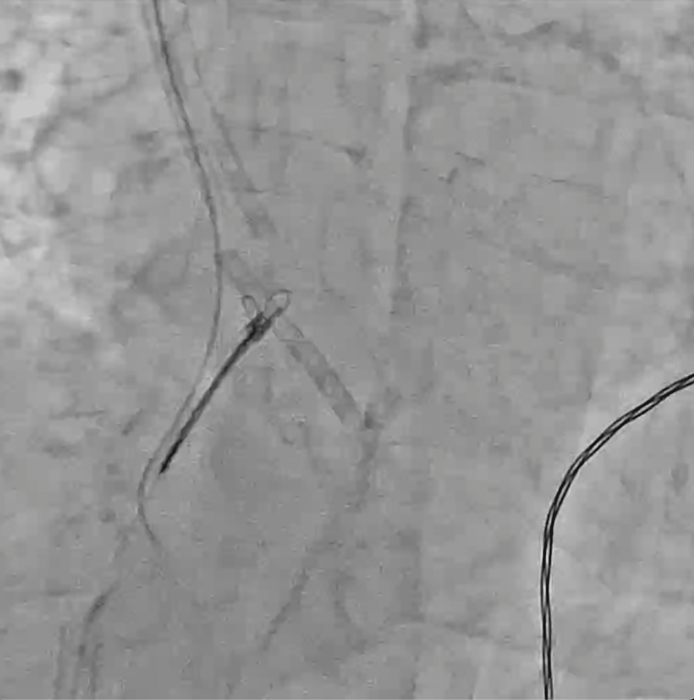 Endovascular Retrieval Of A Fractured Tunneled Hemodialysis Central