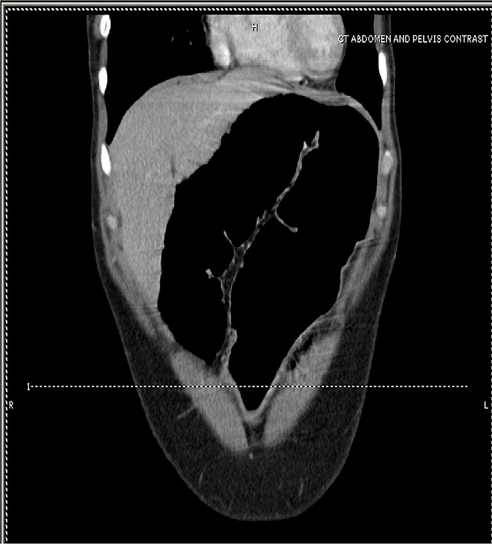 Cureus Imaging, Endoscopic and Assessment of Marfan Syndrome Presenting with Sigmoid