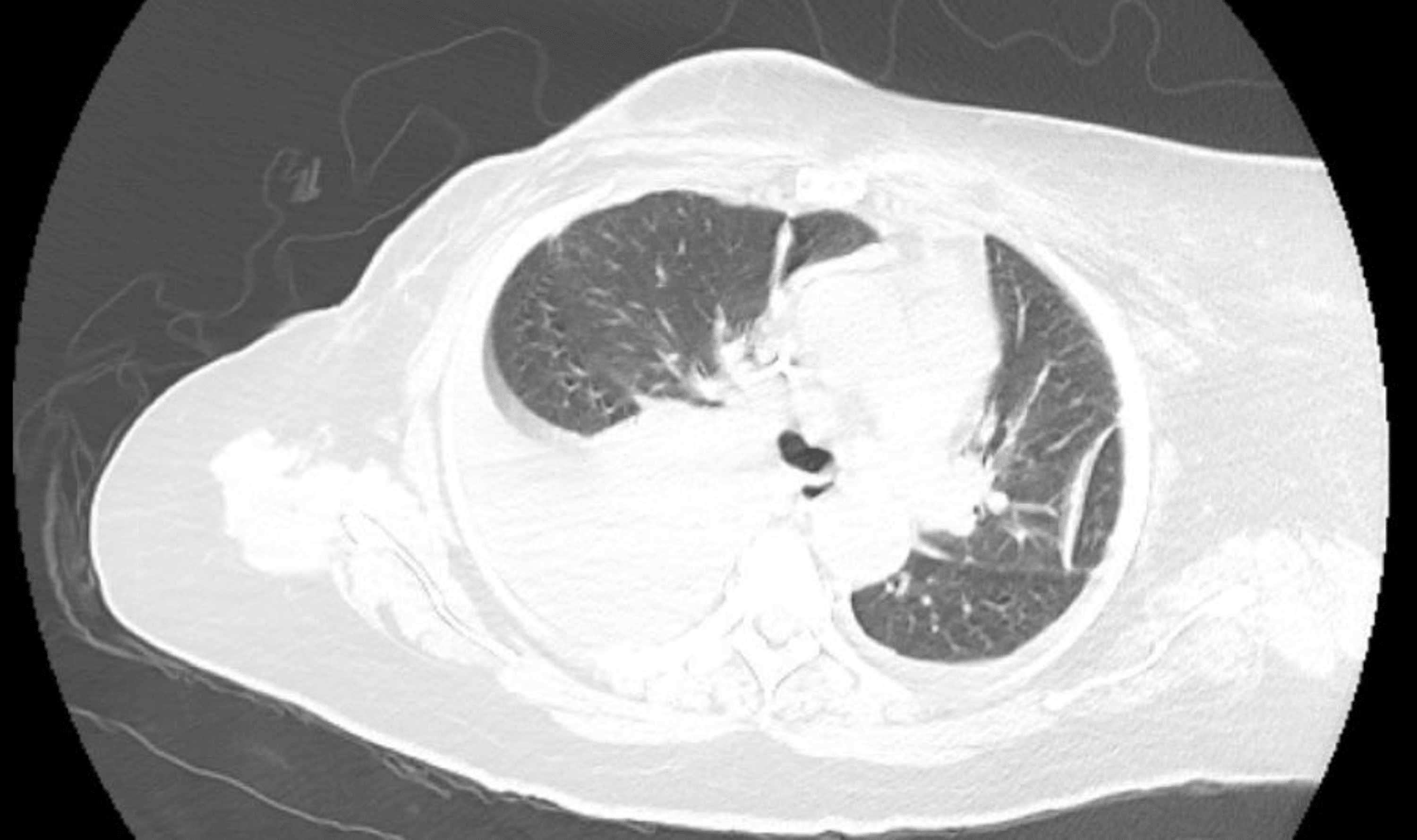 Cureus Malignant Pleural Effusion Due To Uterine Serous Carcinoma An