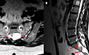 Spinal Cord Stimulation For The Treatment Of Refractory Pain From