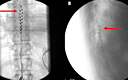 Cureus Spinal Cord Stimulation For The Treatment Of Refractory Pain