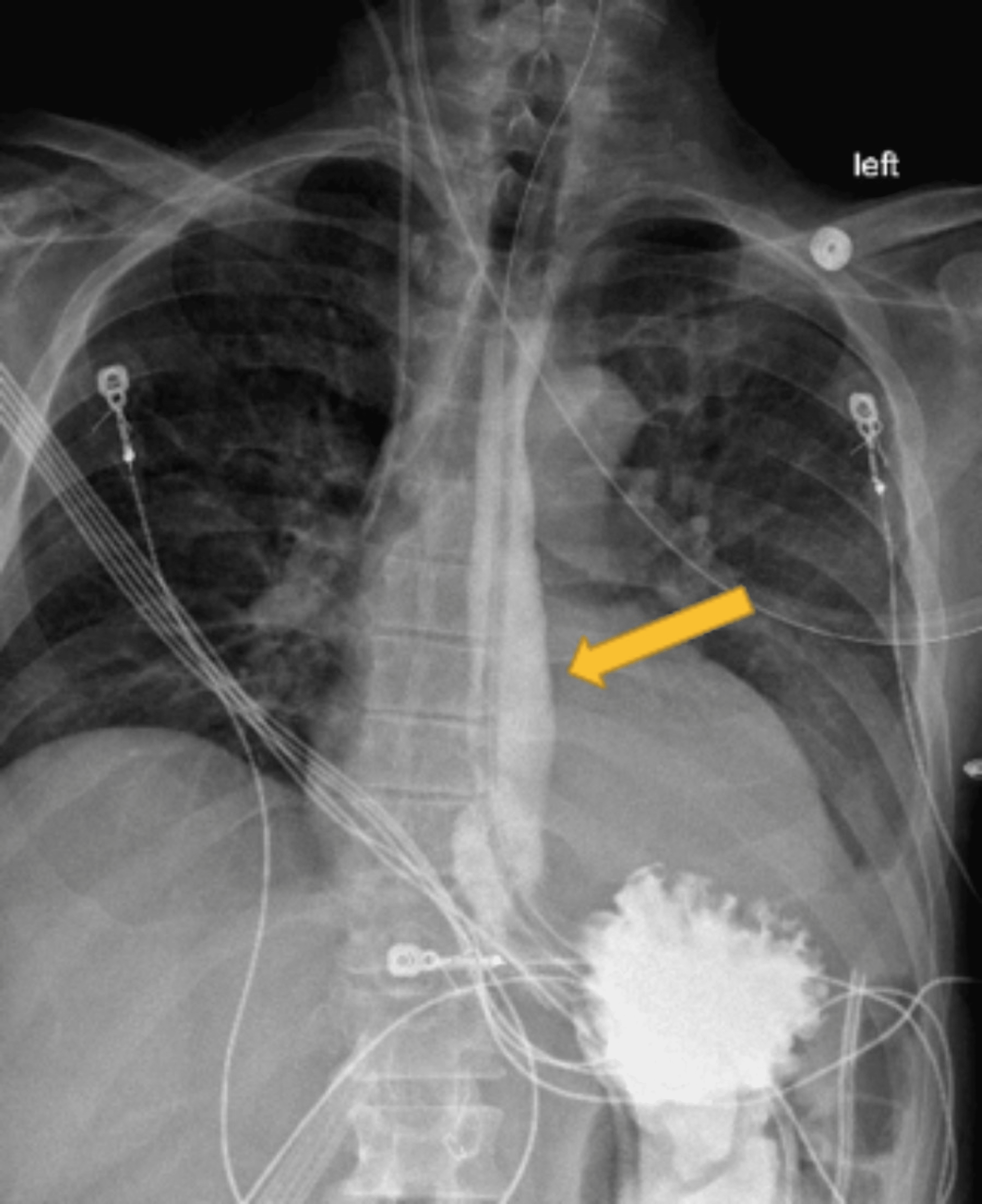 Cureus Closed Loop Gastric Outlet Obstruction Secondary To Duodenal