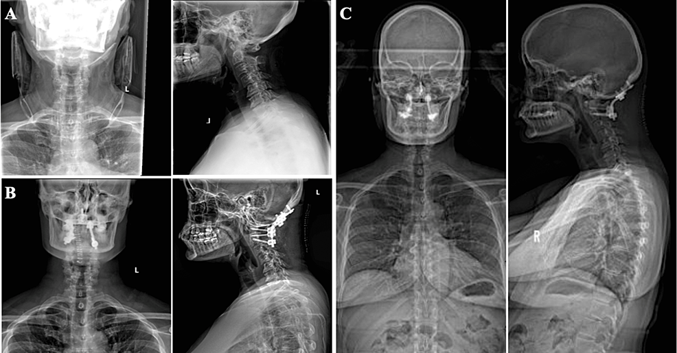 Clear Cell Ovarian Carcinoma With C Lateral Mass Metastasis And