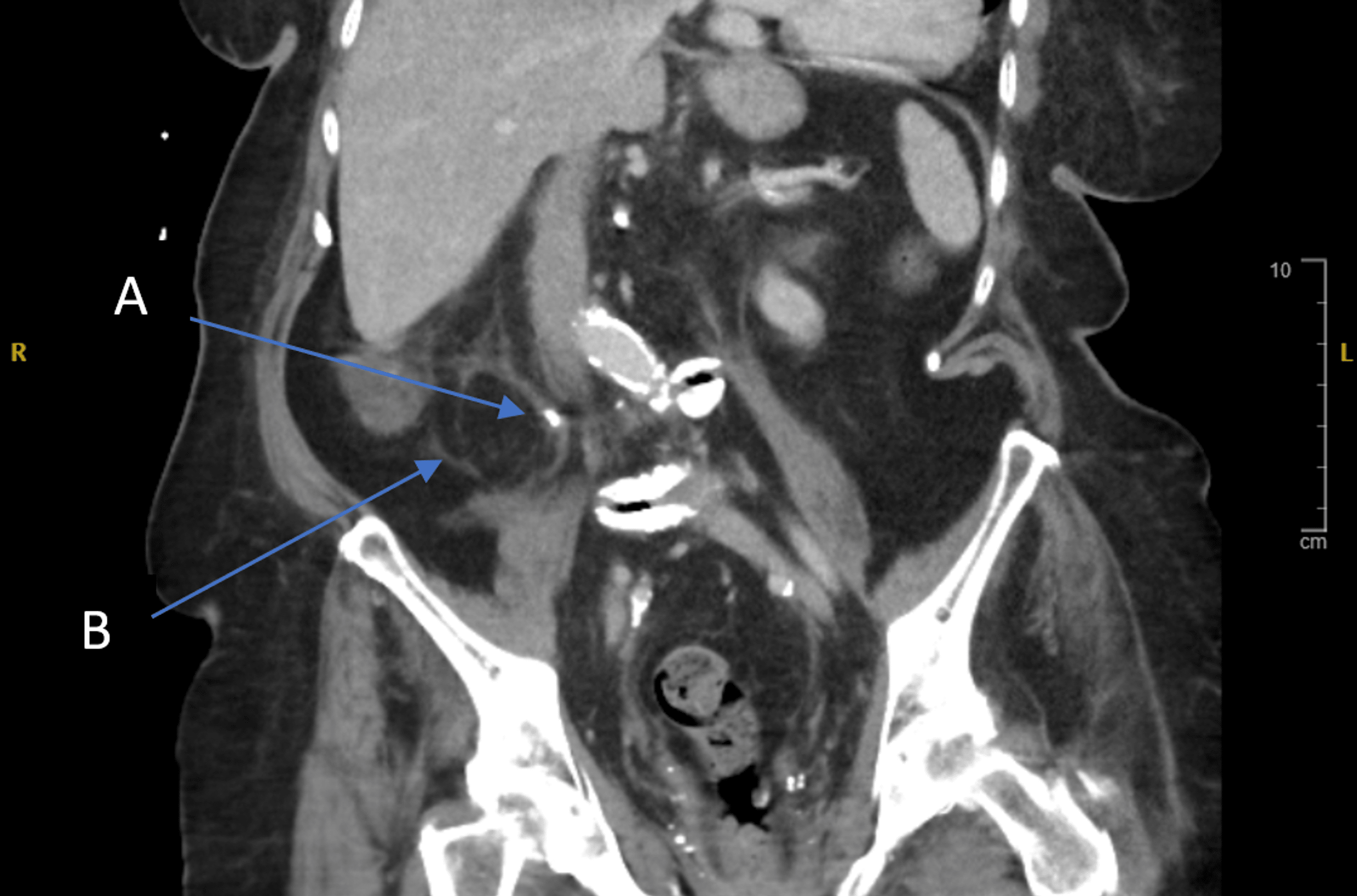 Cureus Bedside Flexible Cystoscopy Guided Ureteric Stent Insertion