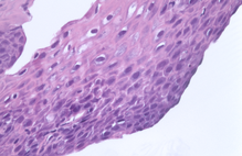 ... Cellulitis of the Breast in an HIV-Negative Patient with Breast Cancer
