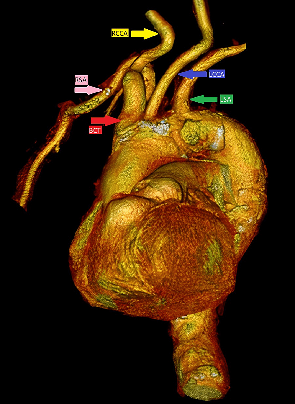 Cureus Anatomical Variations In Aortic Arch Branching Pattern A Computed Tomography