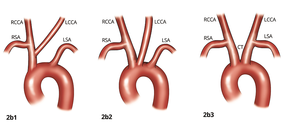 Anatomical Variations In Aortic Arch Branching Pattern A Computed