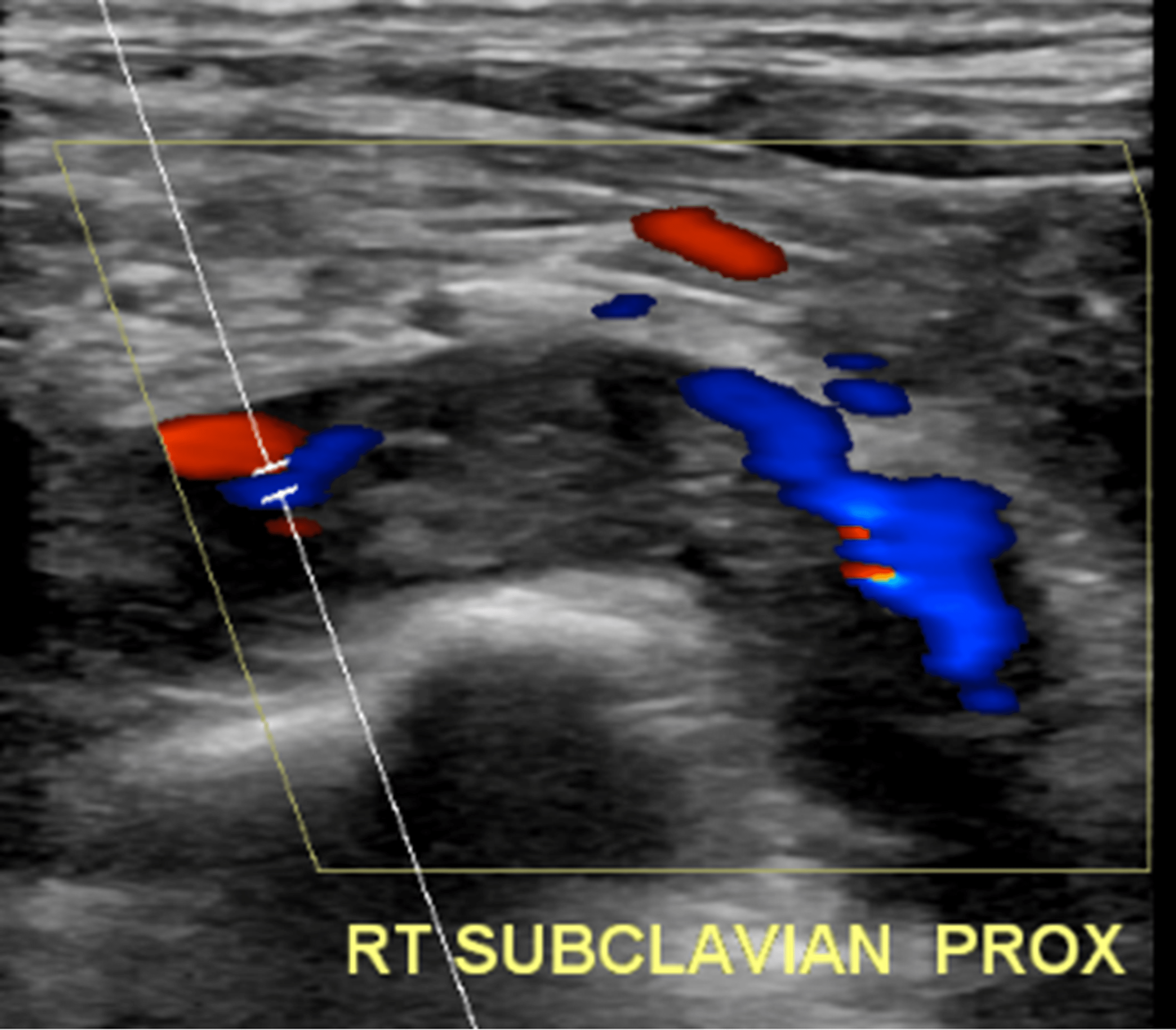 Superficial Venous Thrombosis Of The Brachial Vein With Extension Into