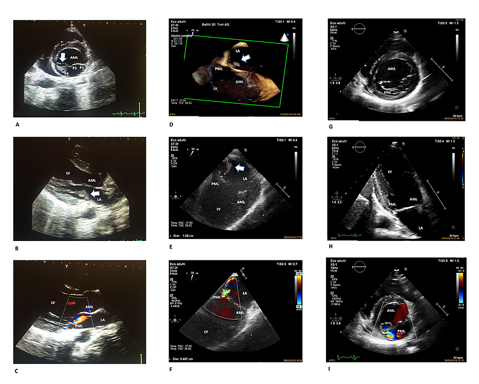 Cureus Mitral Valve Infective Endocarditis Due To Streptococcus Pyogenes A Case Report