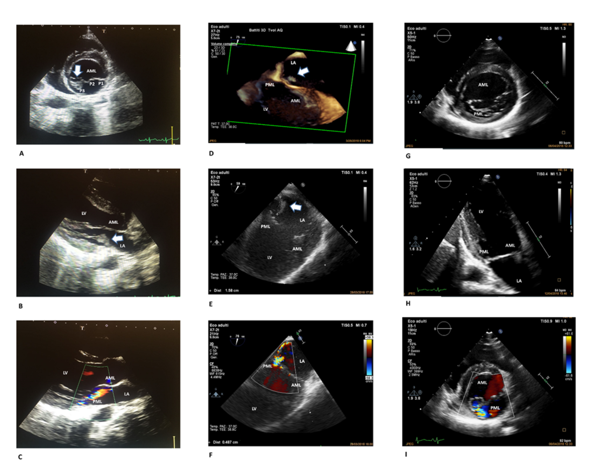 Cureus Mitral Valve Infective Endocarditis Due To Streptococcus