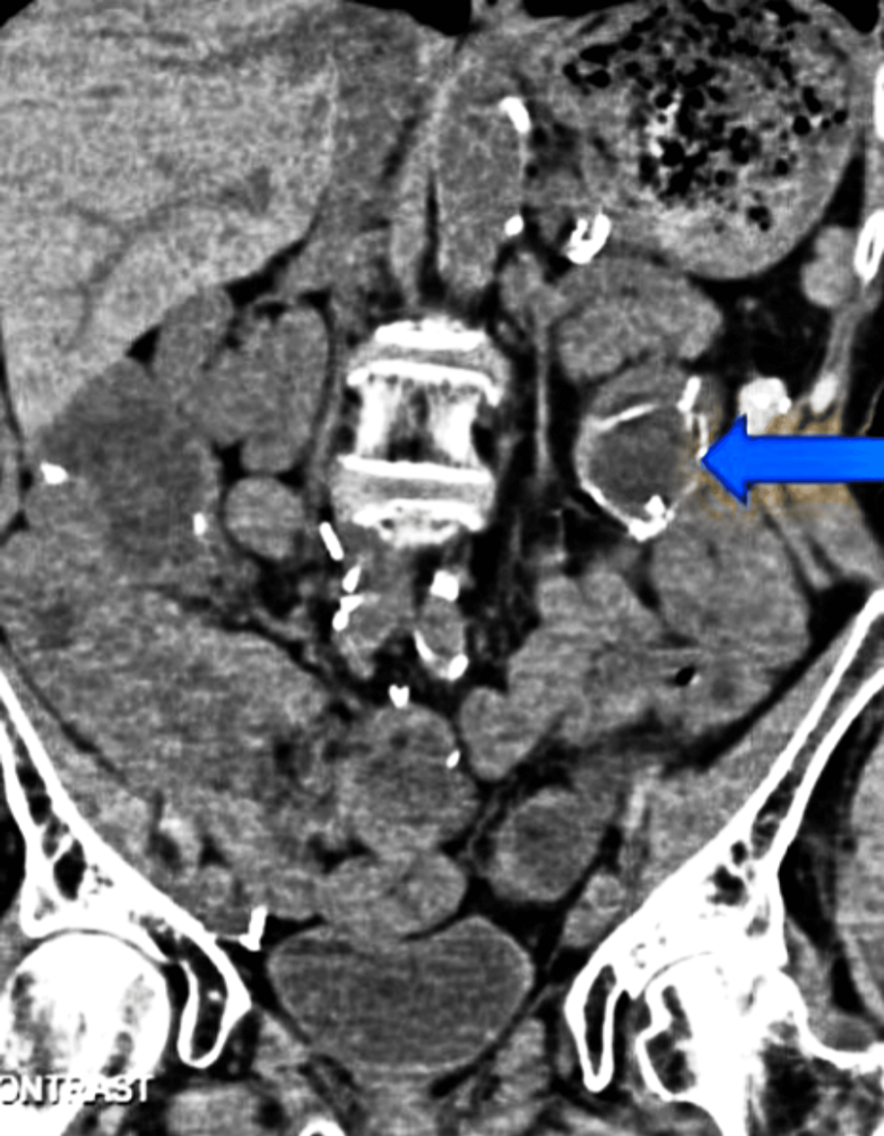 Cureus A Case Report Of Cardiac Failure In A Patient On Teduglutide