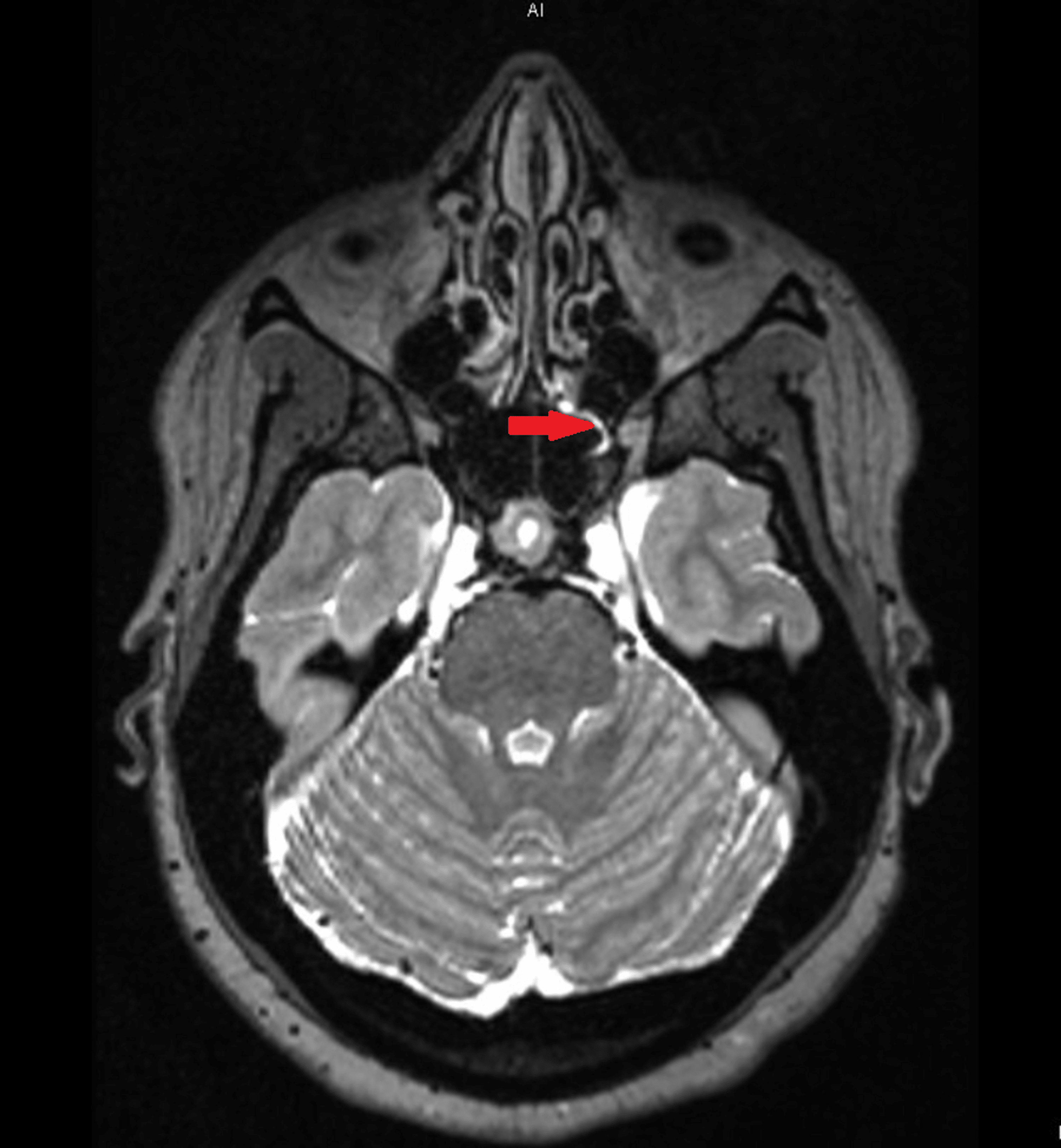 Spontaneous Cerebrospinal Fluid Rhinorrhea Secondary To Idiopathic