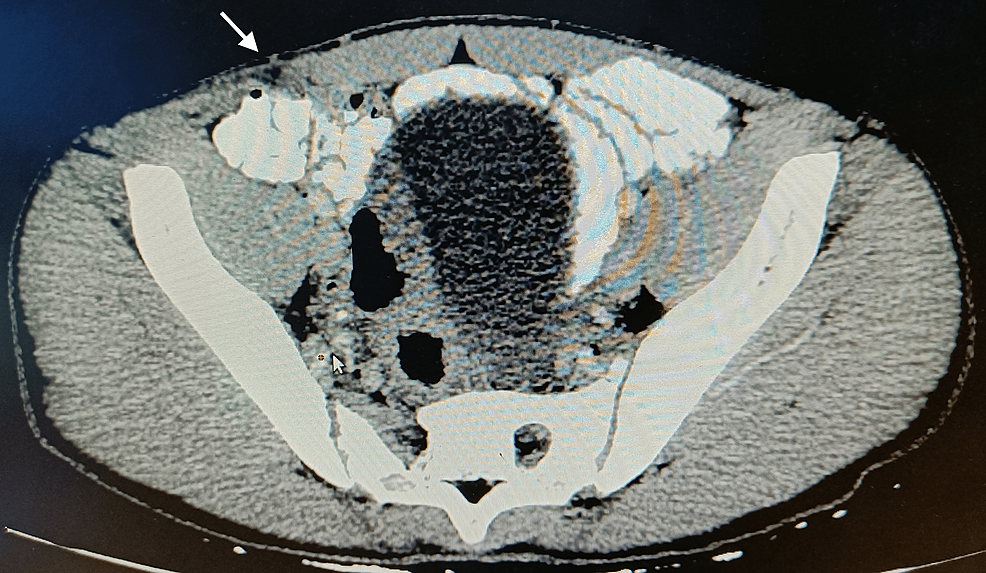 Traumatic Spigelian Hernia Following Blunt Abdominal Trauma Cureus